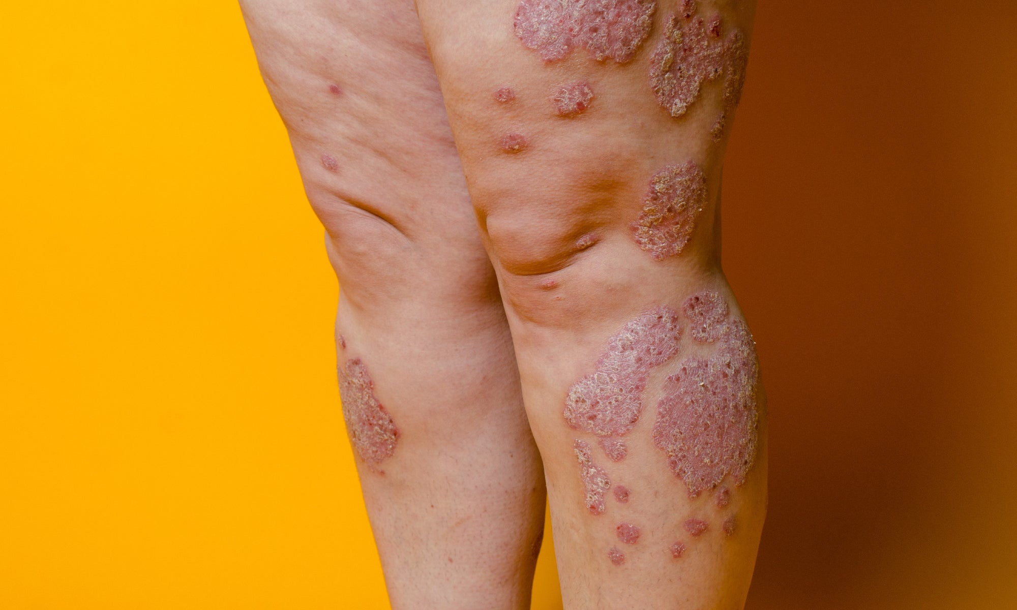 Can Psoriasis Be A Symptom Of Something Else?