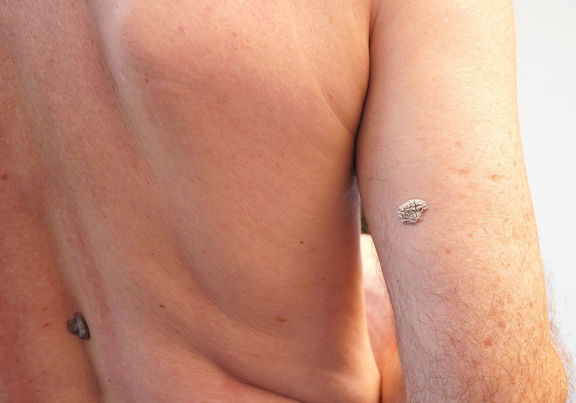2 examples of keratosis on the back of the arm and back
