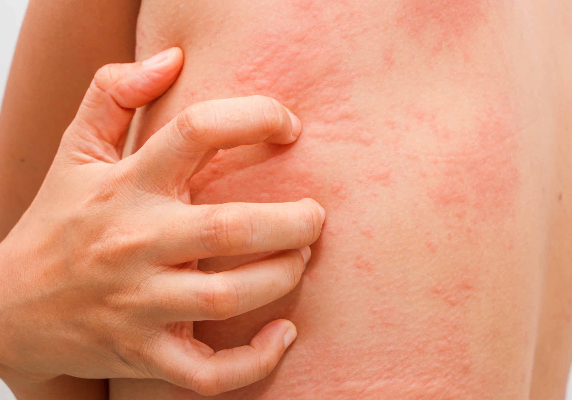 What Is Chemo Rash?