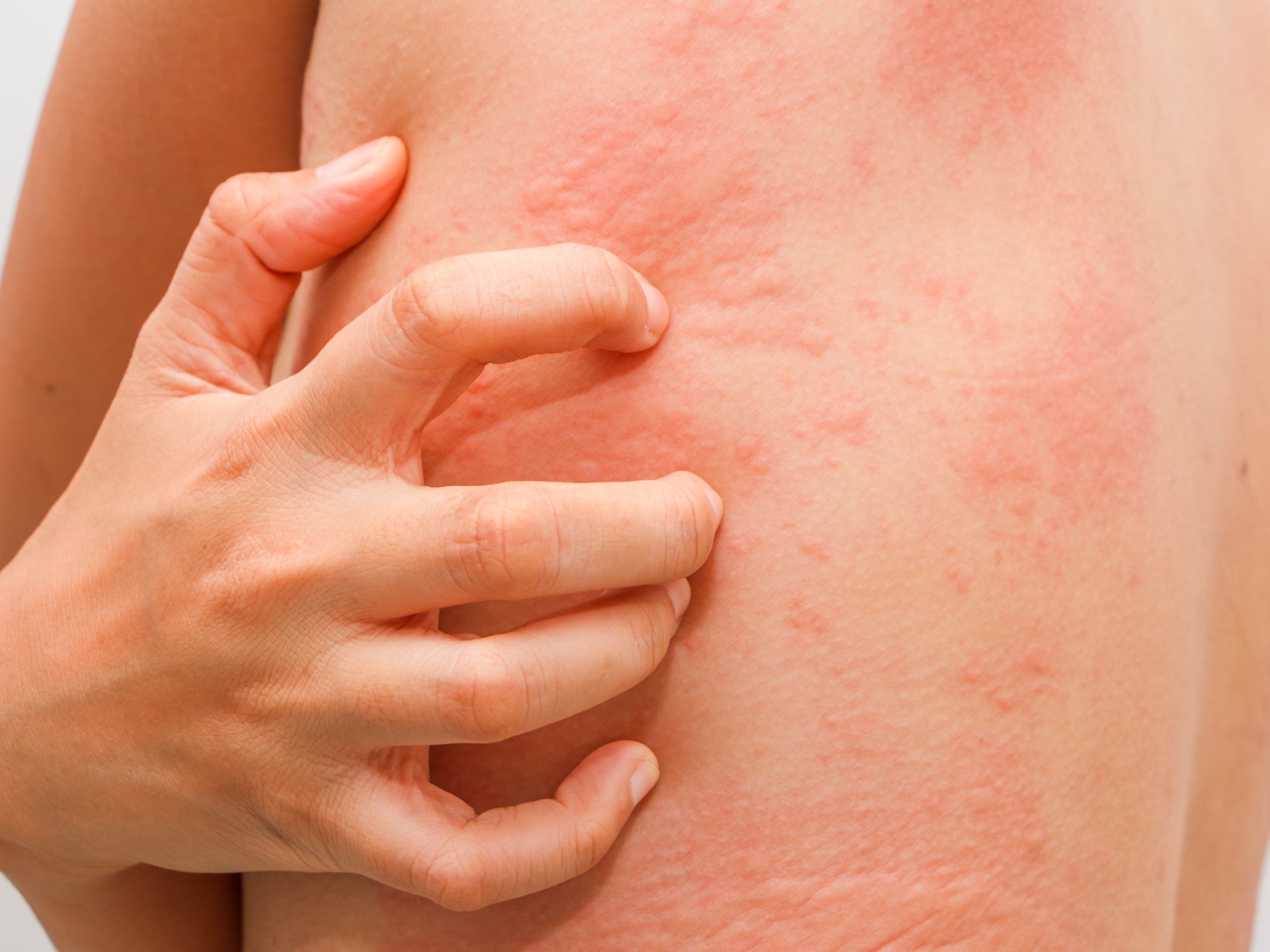 Post Chemo Rash What Is Chemo Rash? – Balmonds