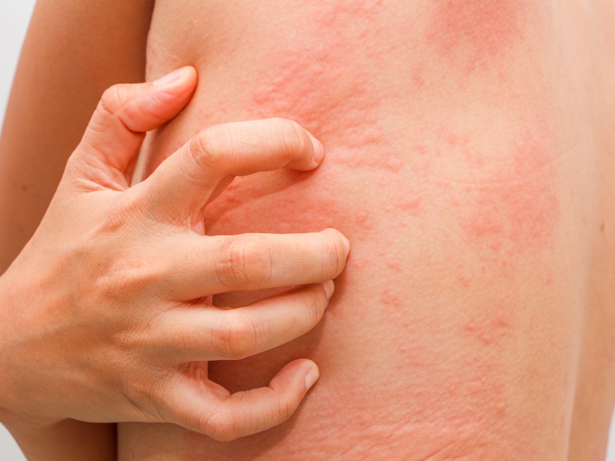 What Is Chemo Rash?