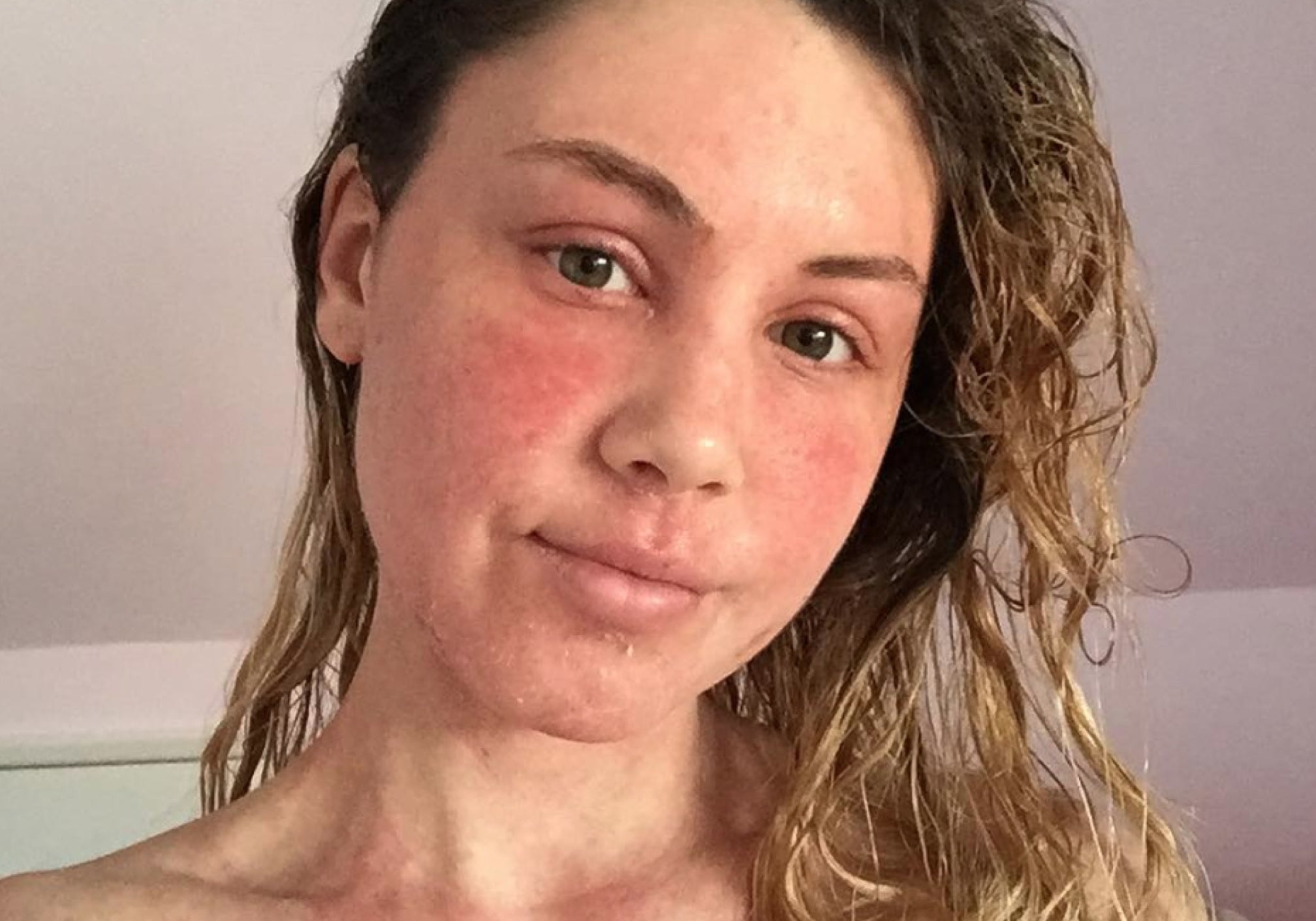 Does Diet Effect Red Skin Syndrome/Topical Steroid Withdrawl (TSW)?