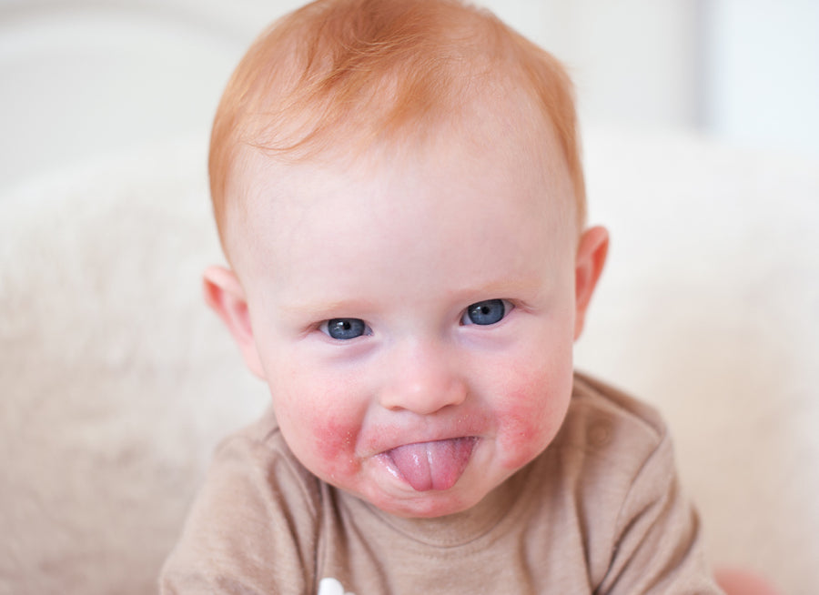 A baby with eczema on cheeks