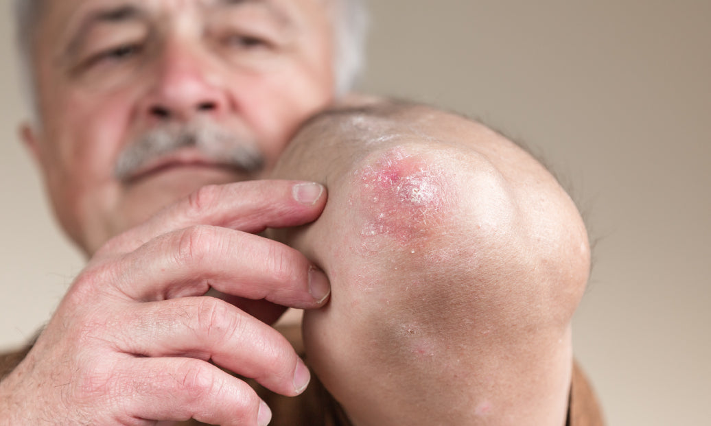 psoriasis on elbow