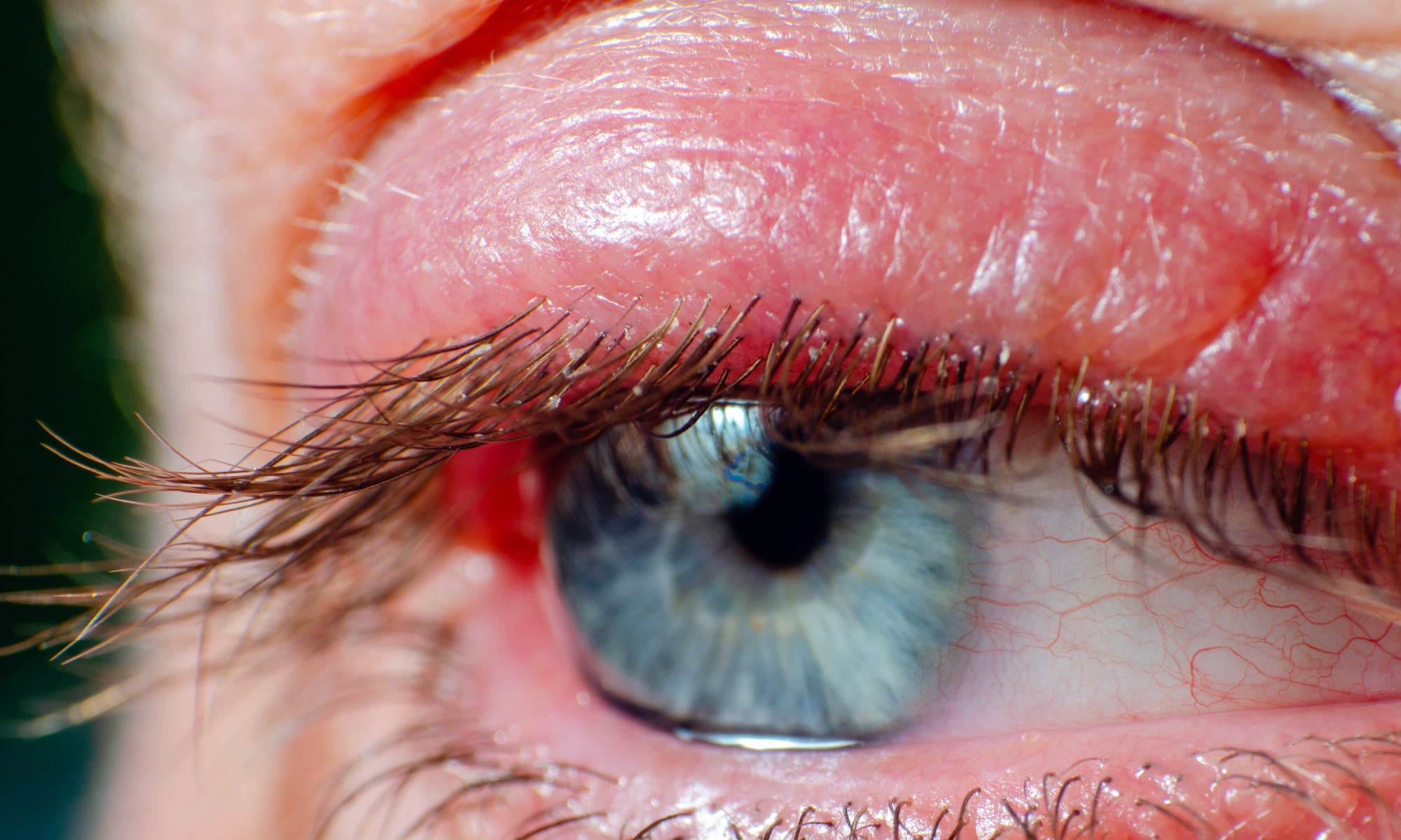 An example of an eye with Blepharitis