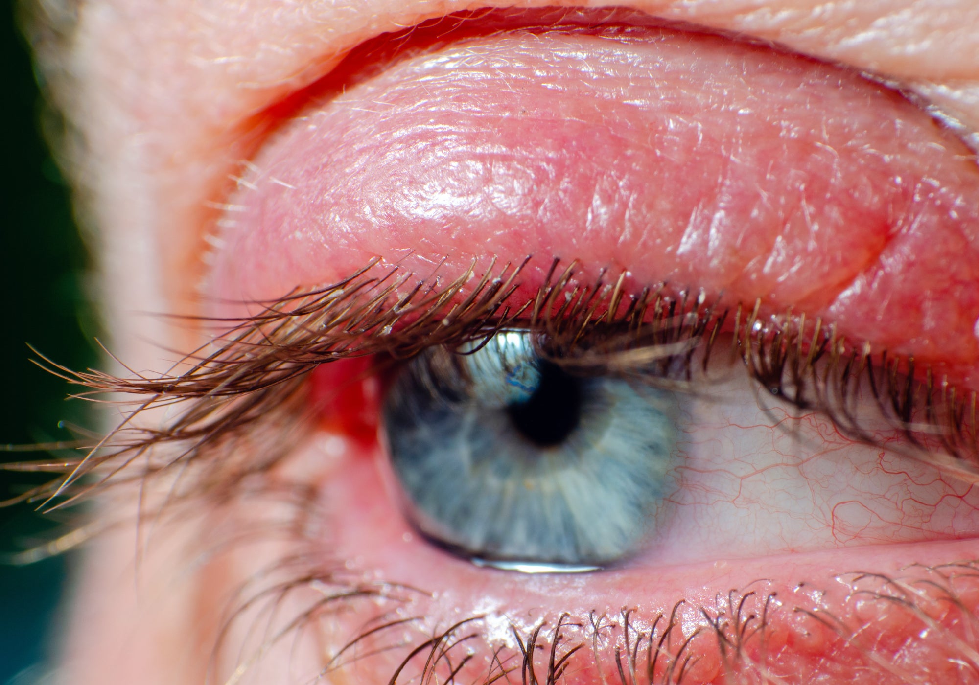 An example of an eye with Blepharitis