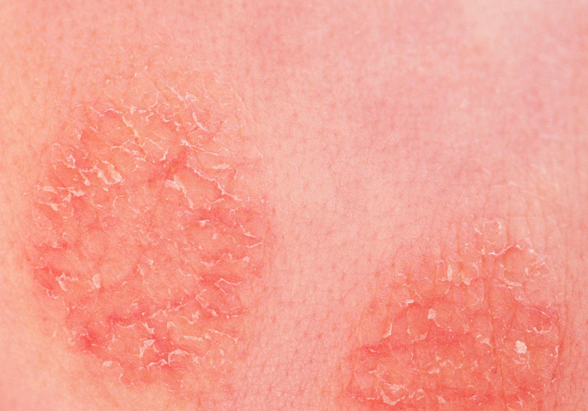Marks on the skin left by eczema 
