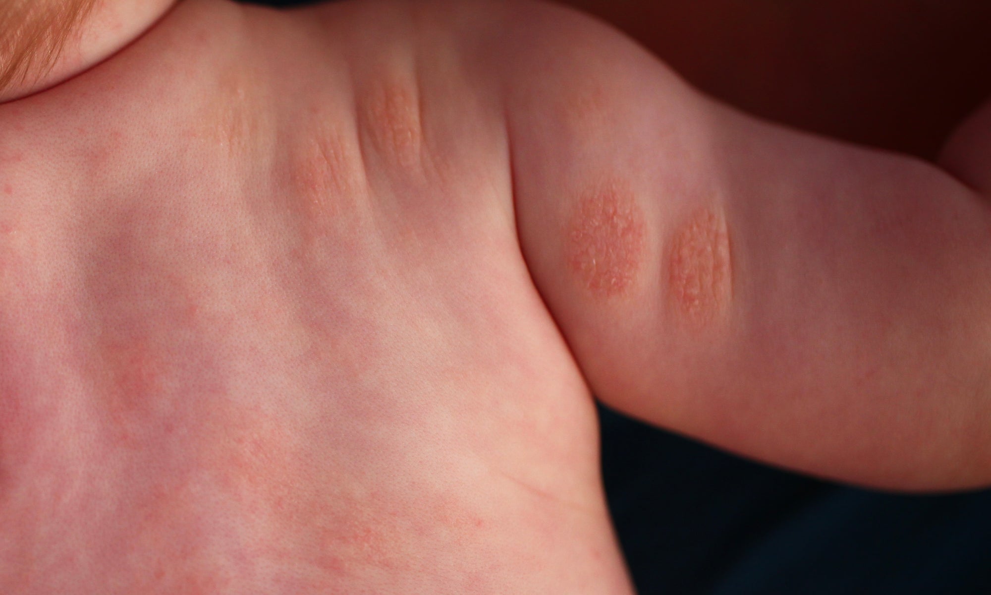 an example of nummular eczema