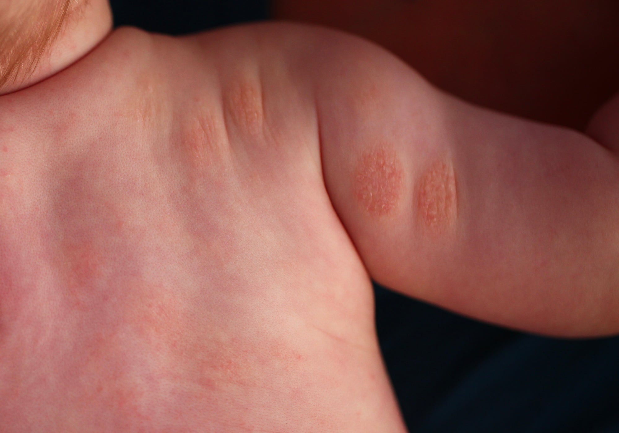 an example of nummular eczema