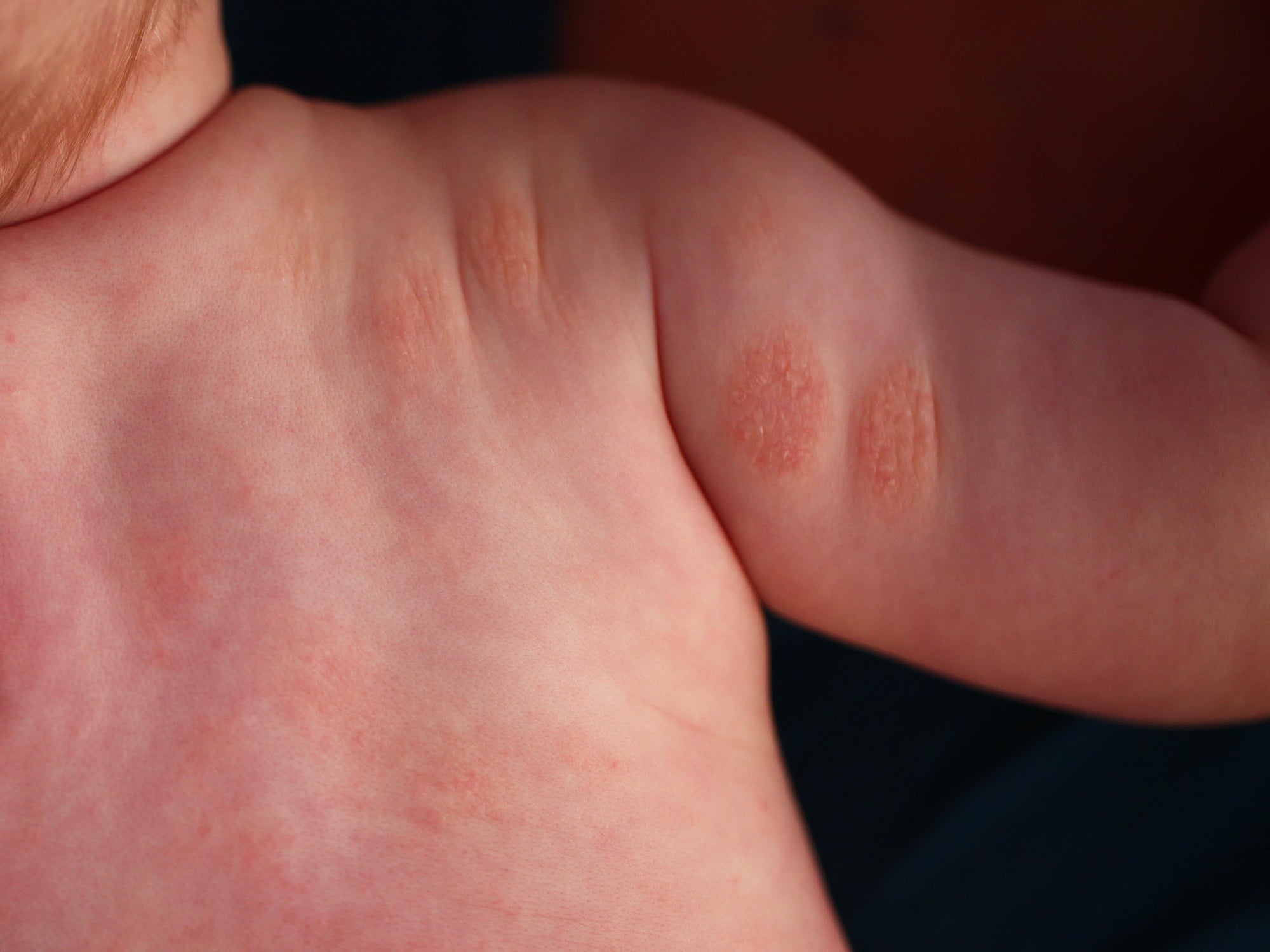 an example of nummular eczema