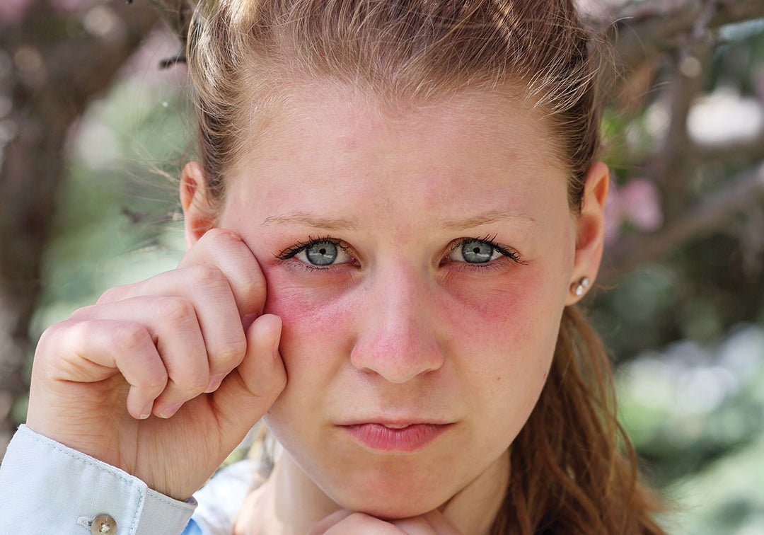 Does Hayfever Make Your Skin Itch?