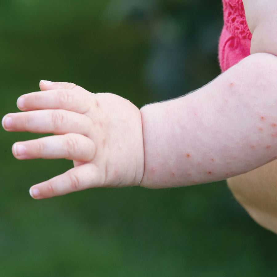 Is Your Eczema Cream Giving You An Itchy Rash? – Balmonds
