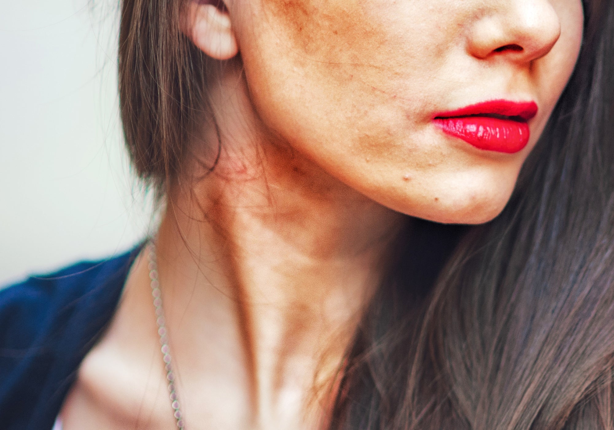 Does Hyperpigmentation Fade Away Naturally?