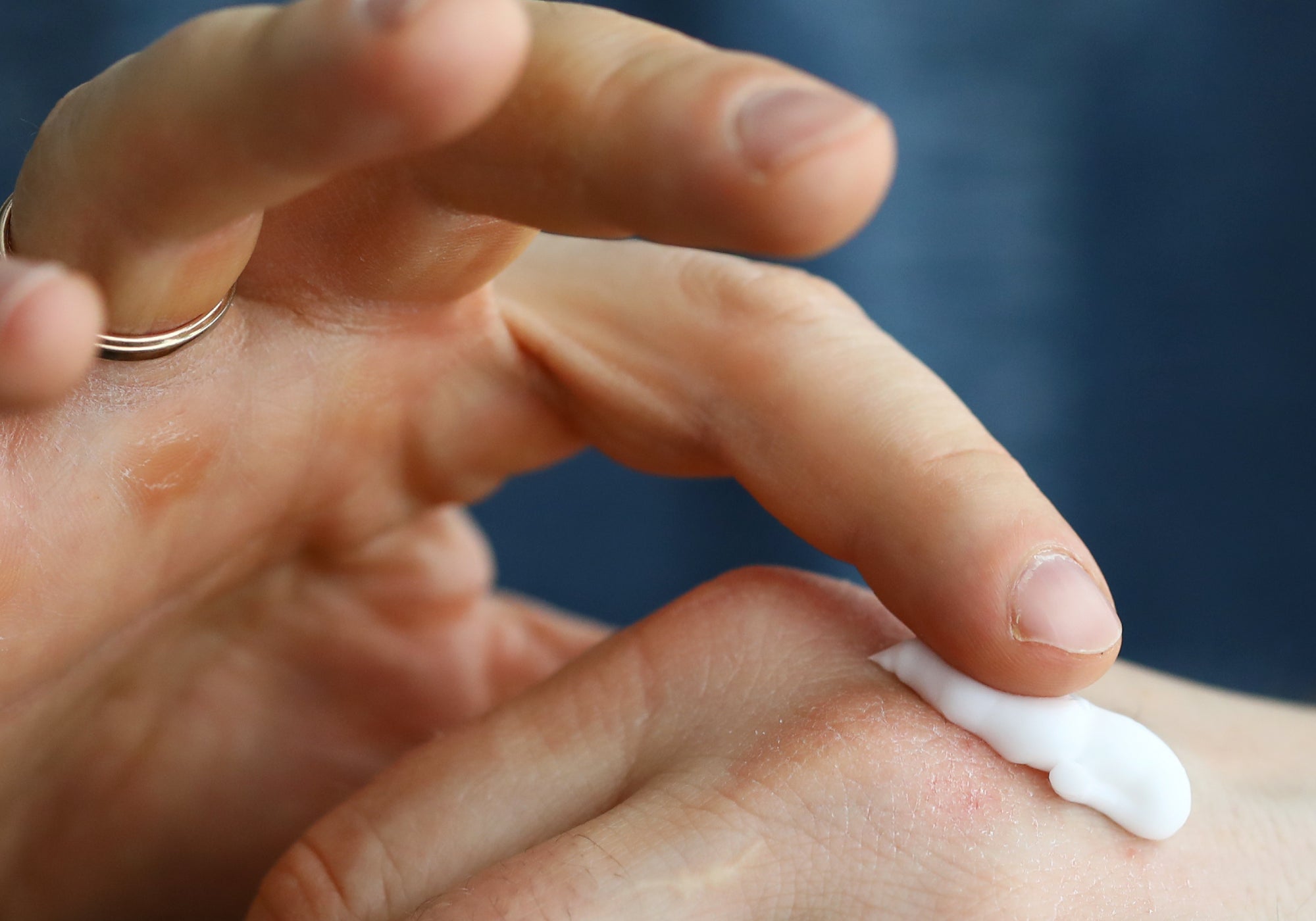 Why Do My Hands Burn When I Put Cream On?