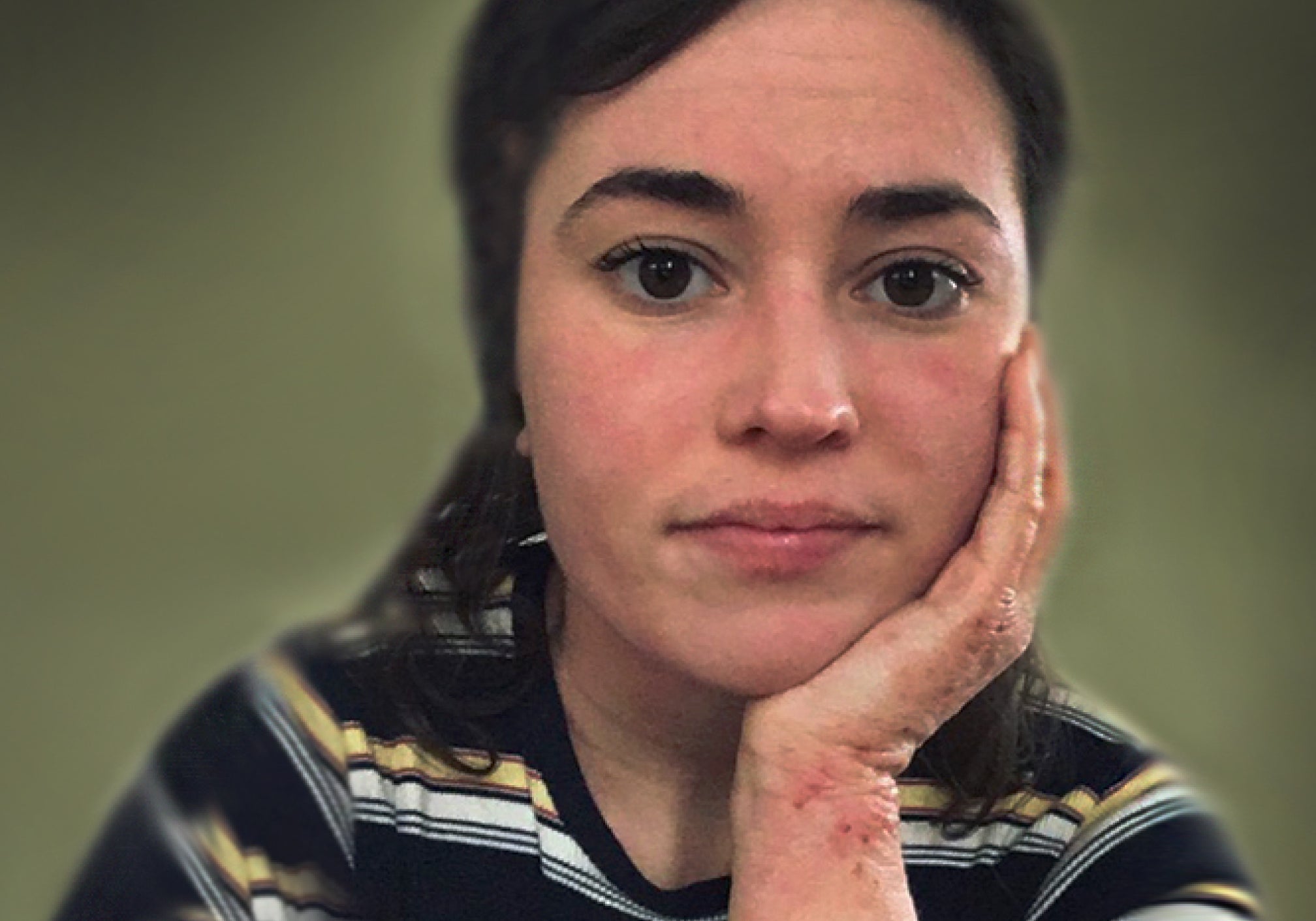 What Are The Stages Of Topical Steroid Withdrawal?