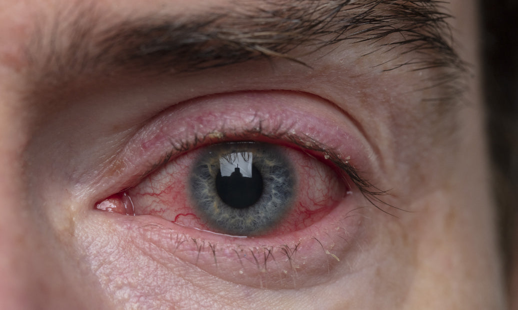 An eye showing Blepharitis 