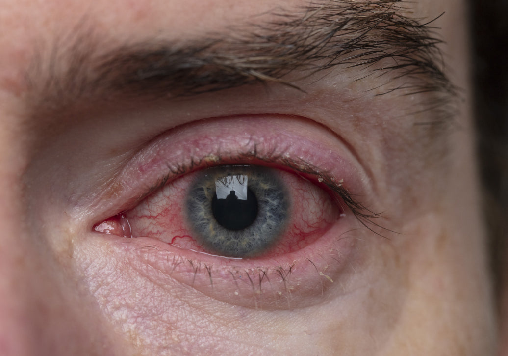 An eye showing Blepharitis 