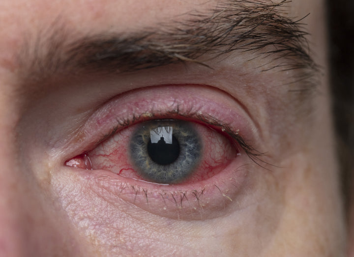 An eye showing Blepharitis 