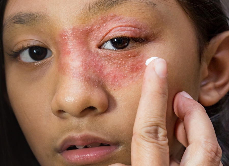 Young woman with dermatitis around the eyes