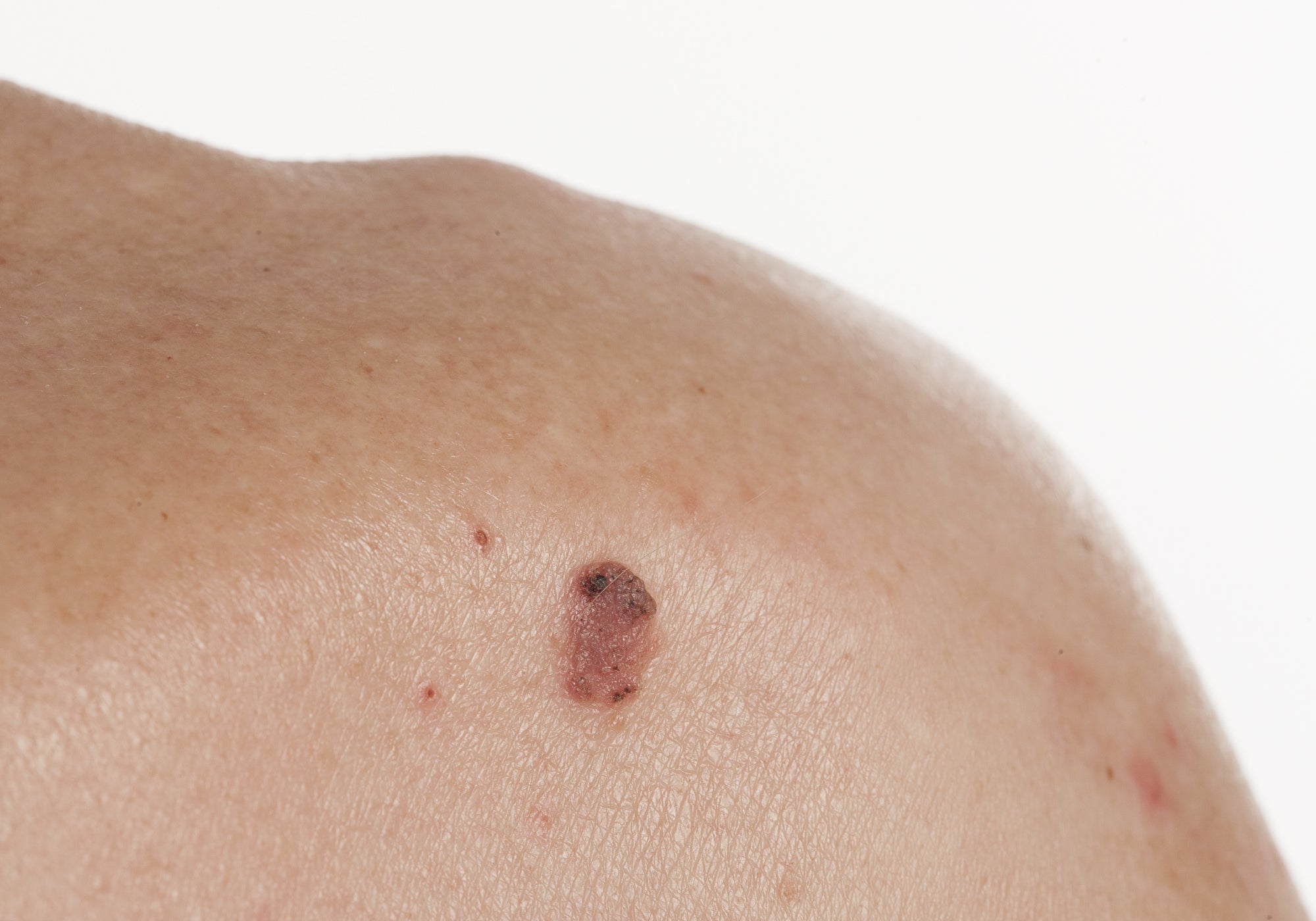 a small red area of skin with a darker area at the top