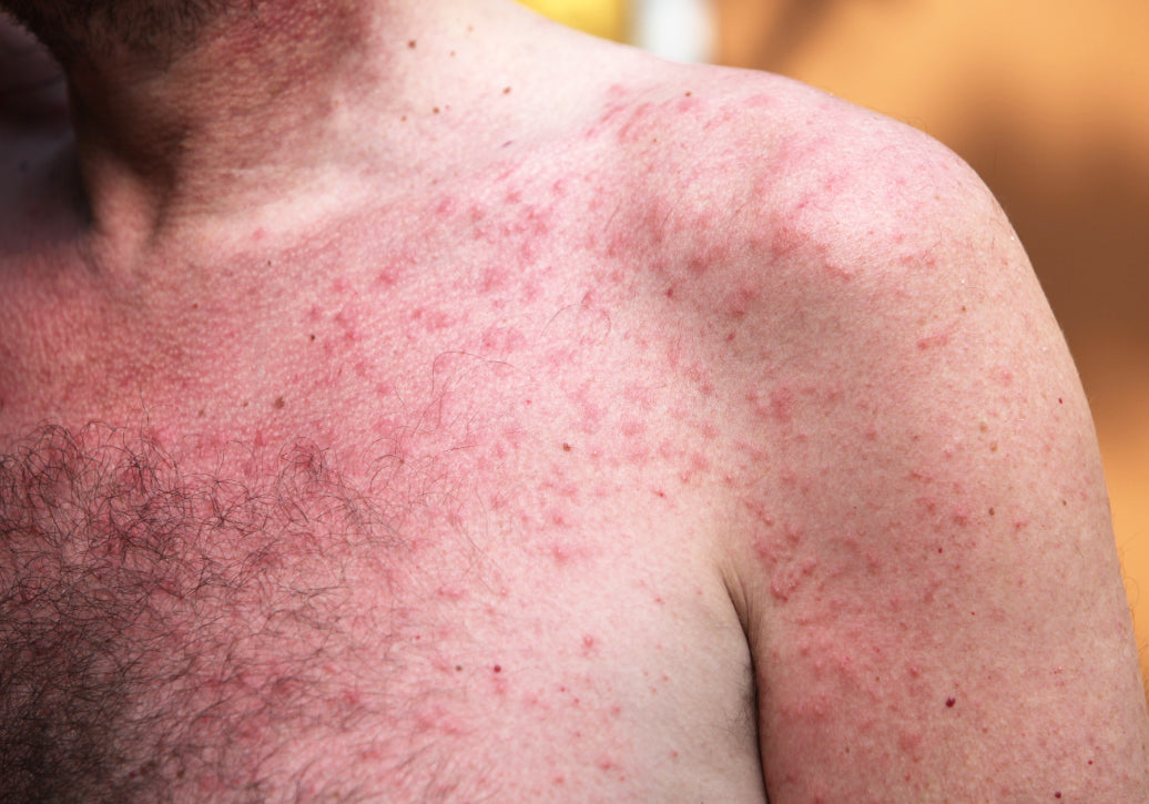 Polymorphic Light Eruption on chest and shoulders