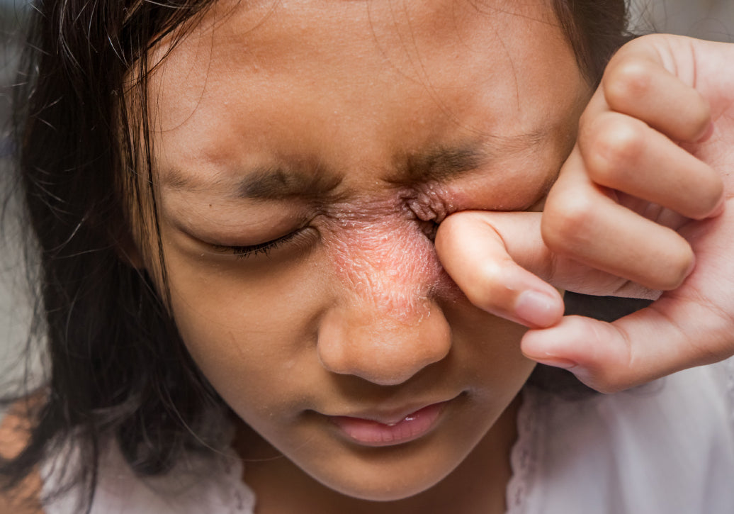 Young person with Periocular Dermatitis, rubbing their eye