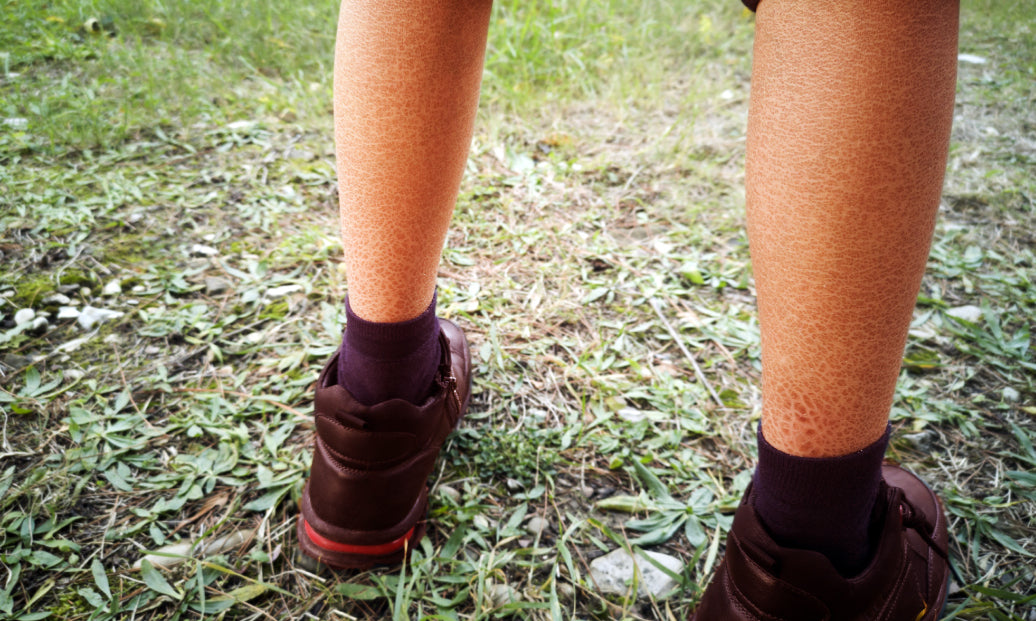  Ichthyosis on the back of lower legs