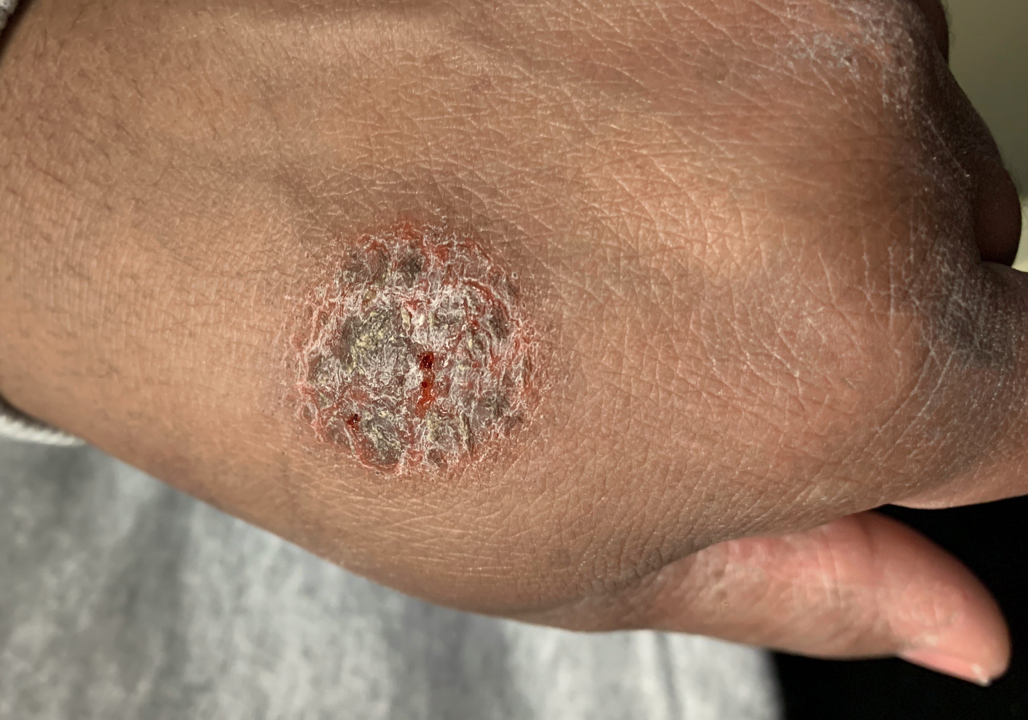 A patch of Discoid Eczema on the back of a hand