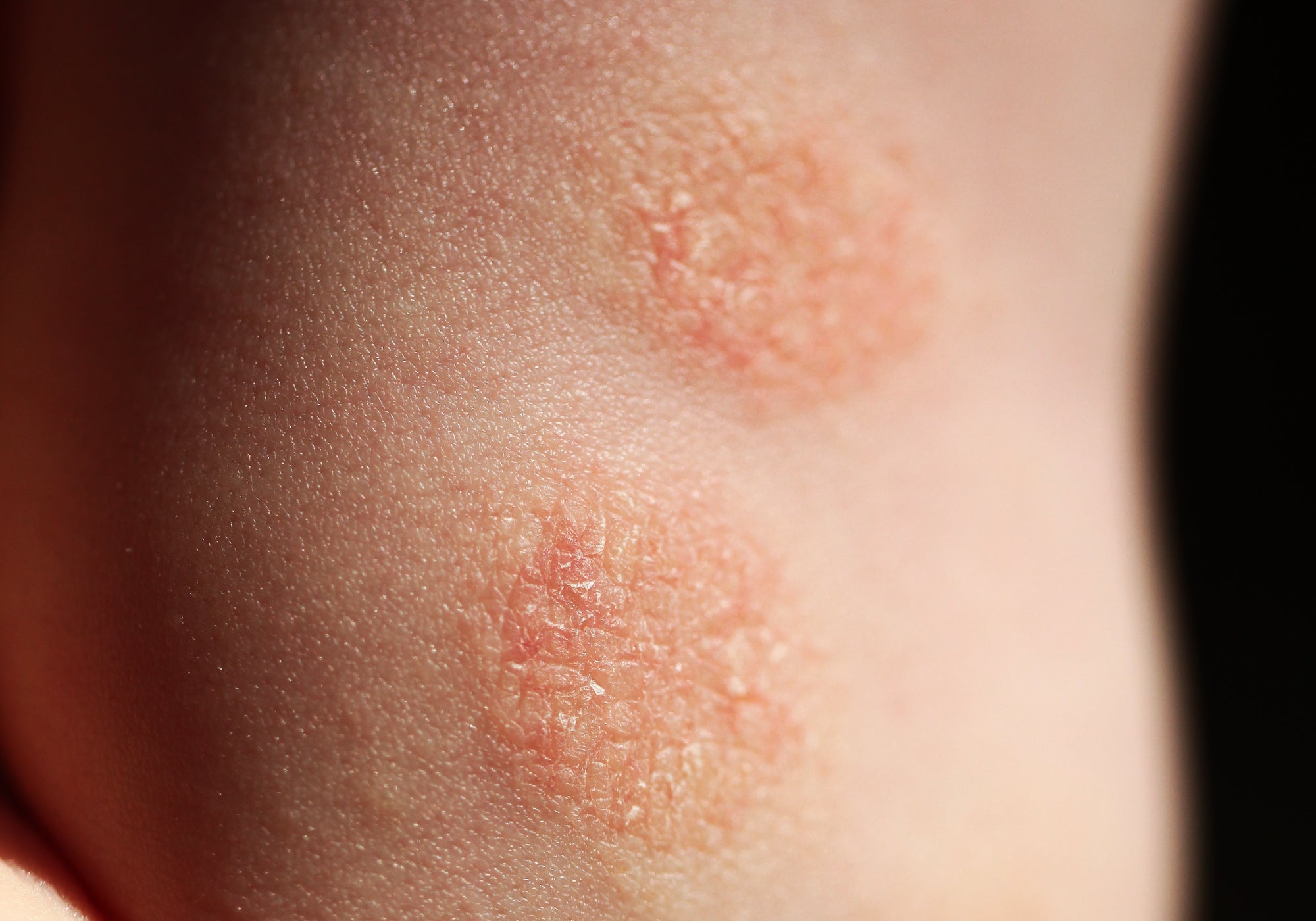 An example of nummular eczema