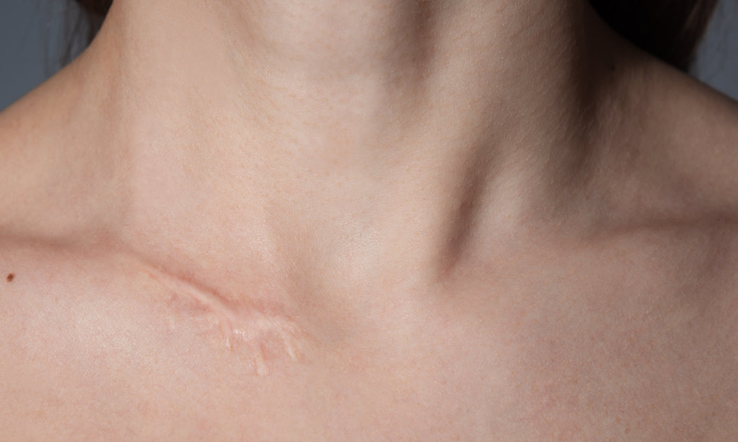 a scar on a neck