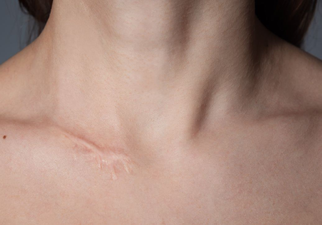 a scar on a neck