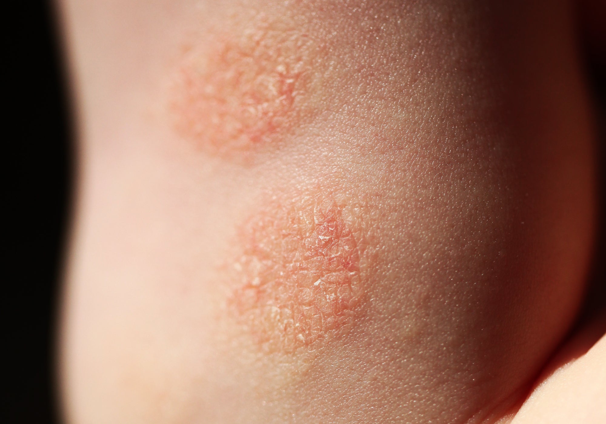 an example of discoid eczema