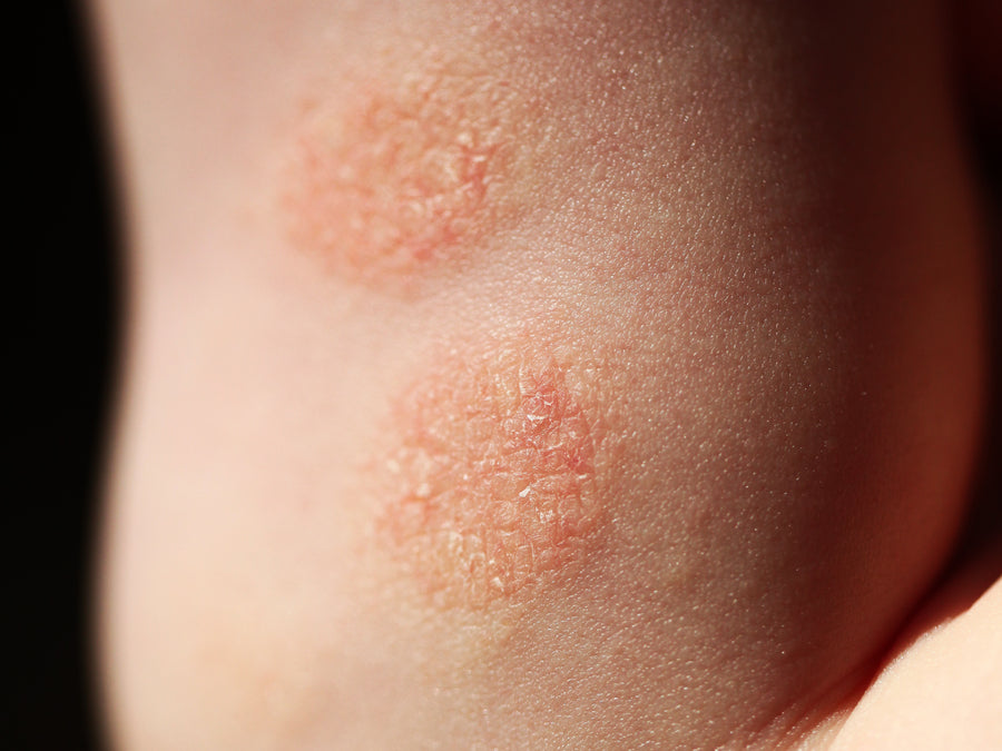 an example of discoid eczema