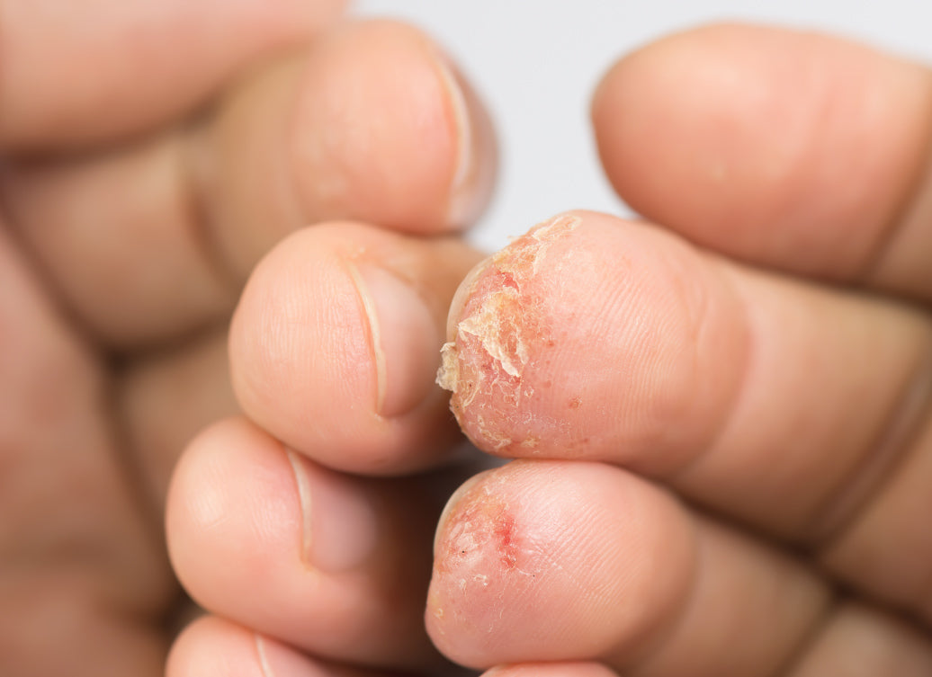 Dyshidrosis at the end of fingers