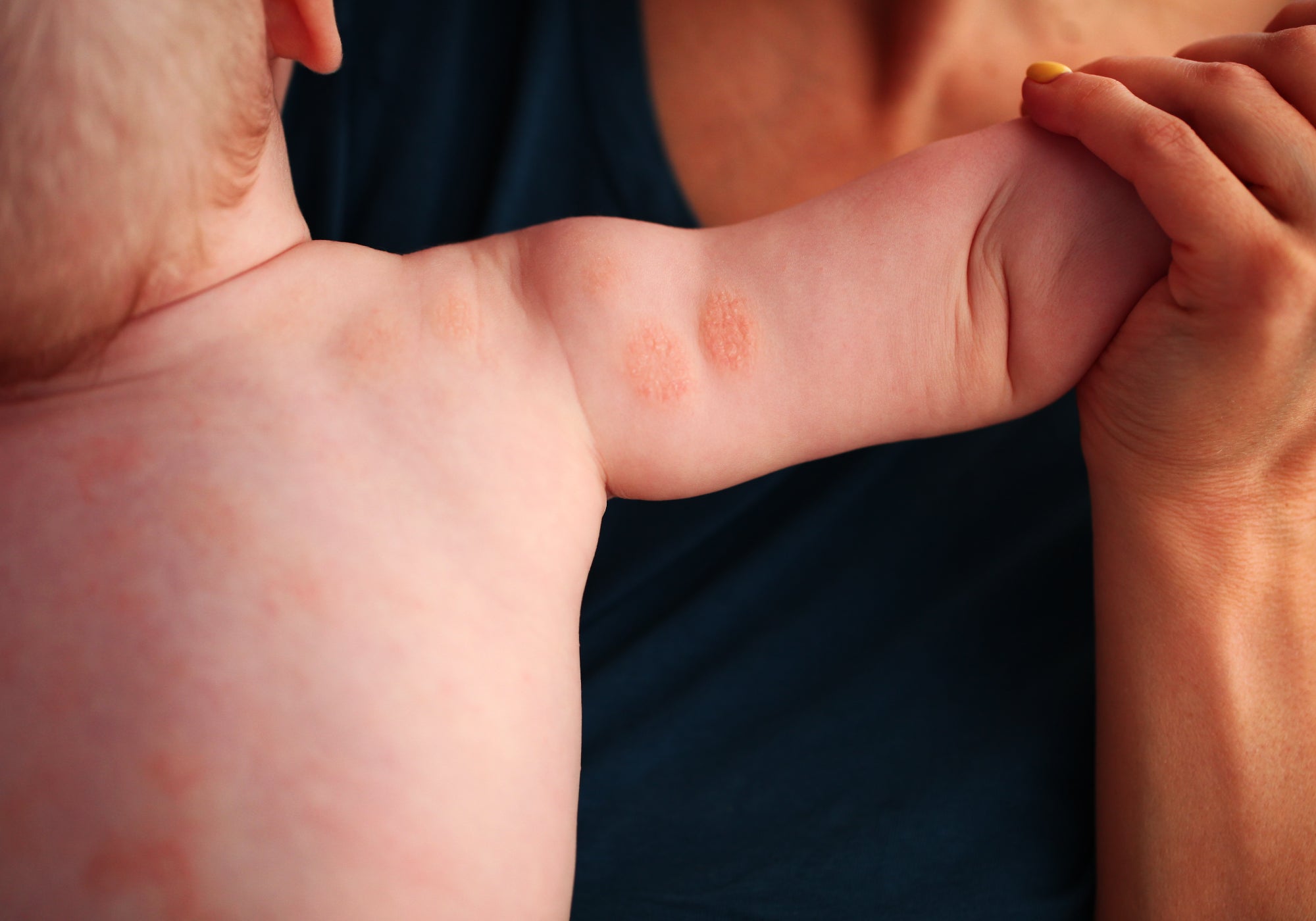 Some discoid eczema on the back of a babies arm