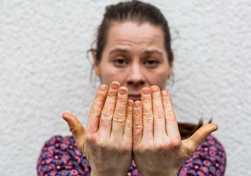 eczema on hands