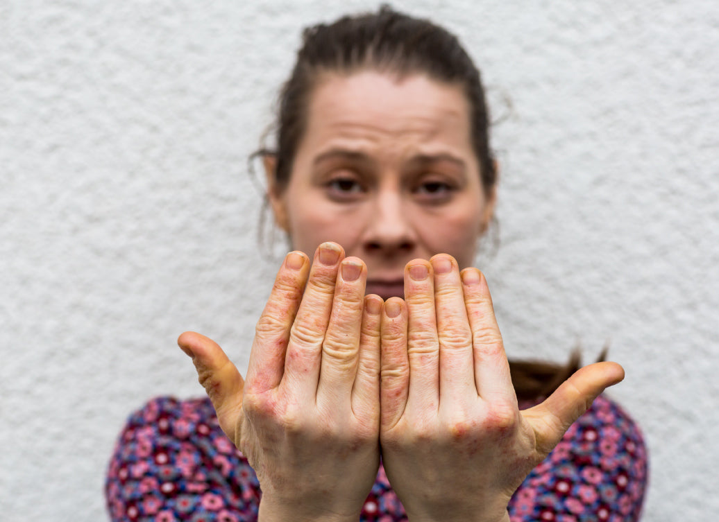 eczema on hands