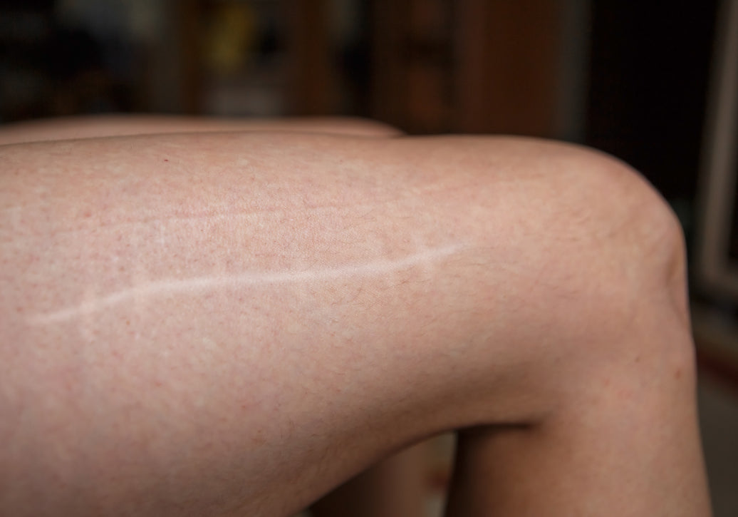 scar on a leg