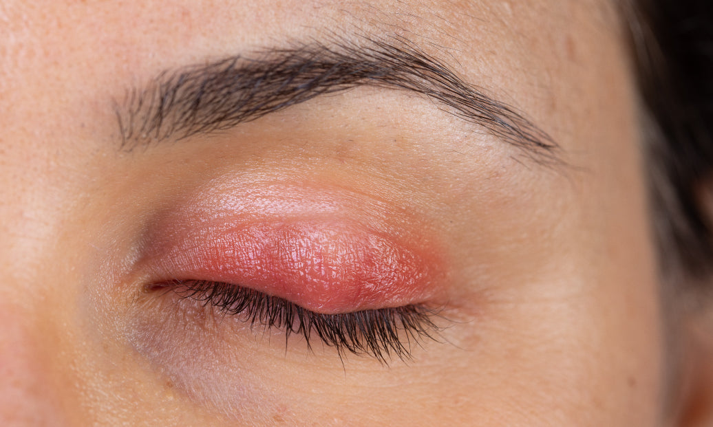 Blepharitis on eye lid