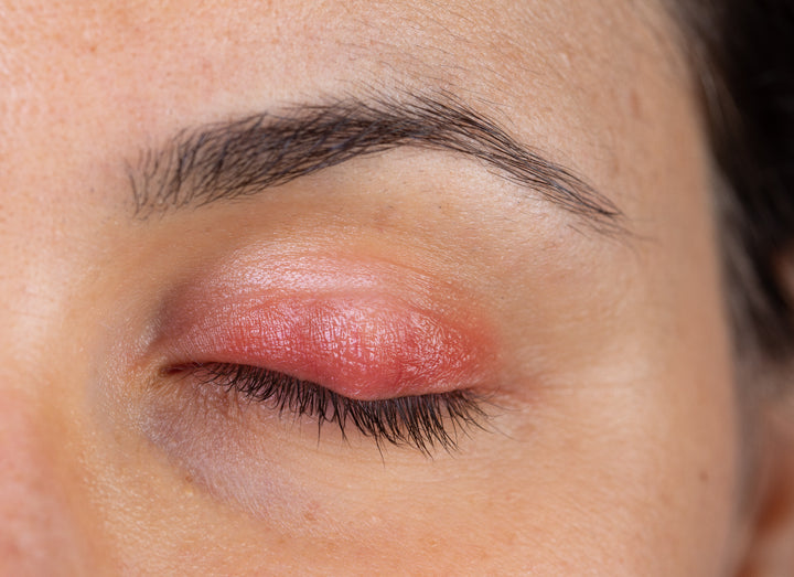 Blepharitis on eye lid
