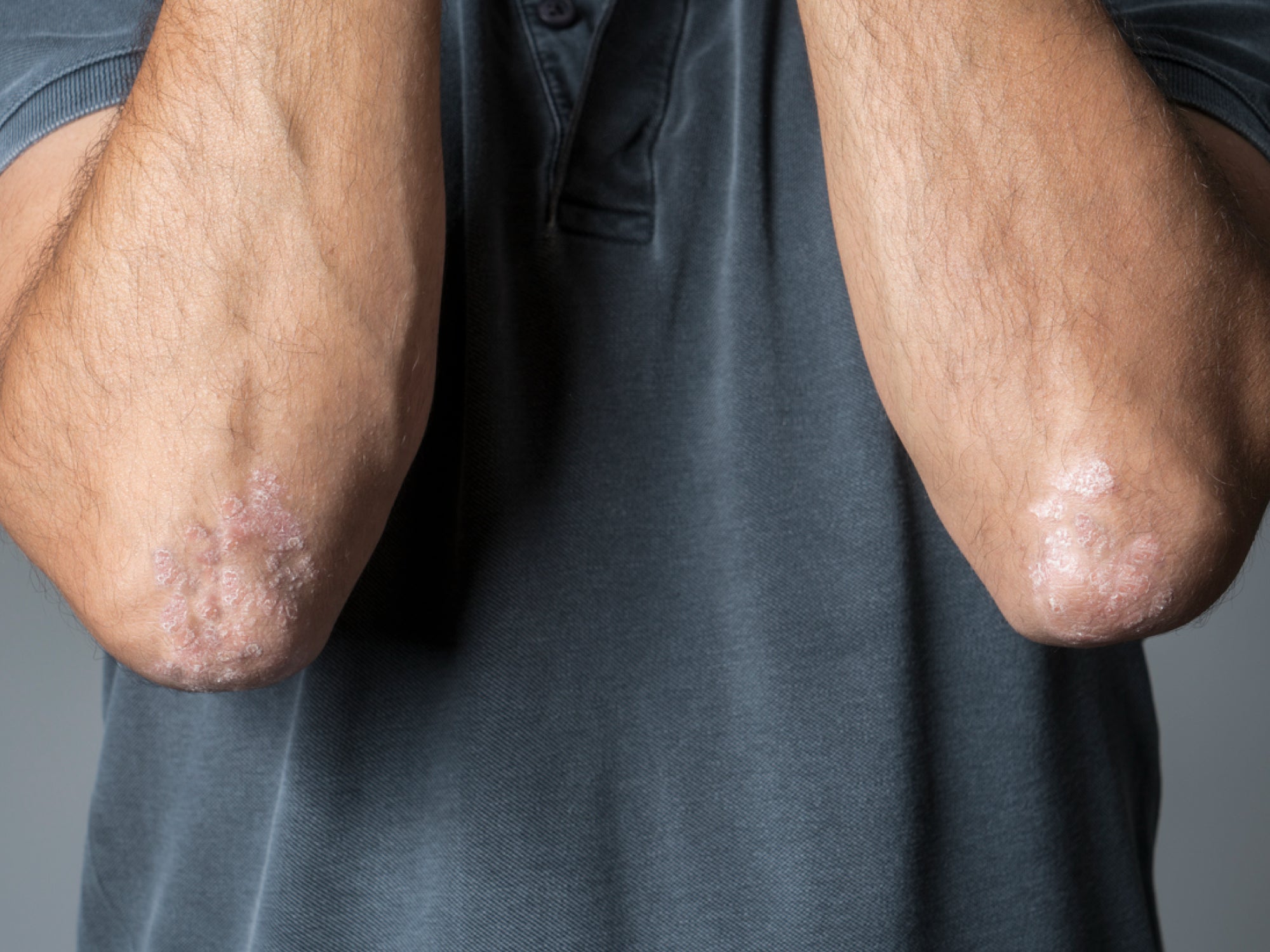 How Do You Stop Psoriasis From Spreading? Balmonds