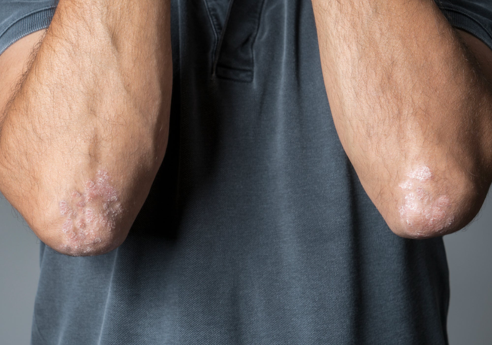 How Do You Stop Psoriasis From Spreading?