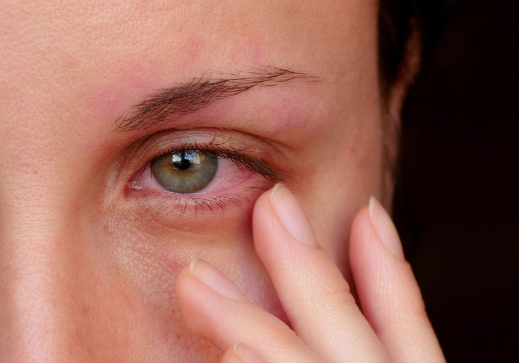 Example of Blepharitis 