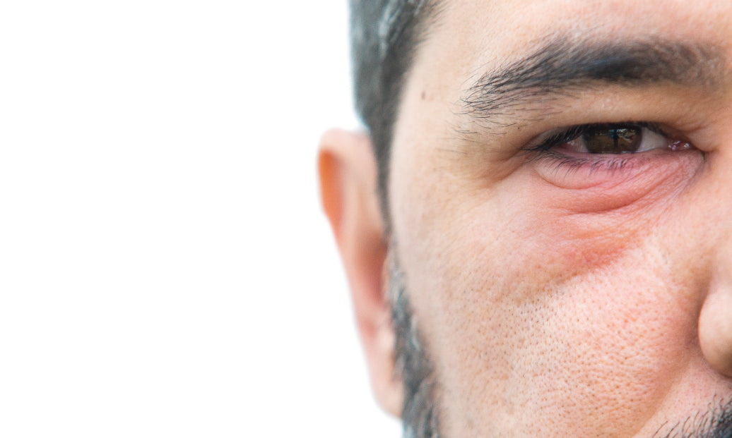 Blepharitis around the eye