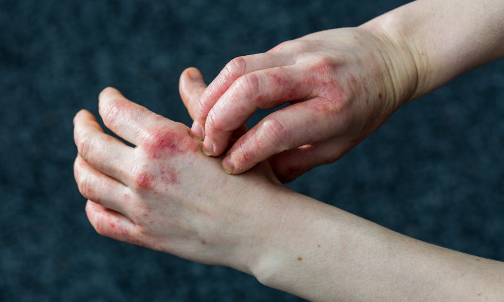 scratching Dyshidrosis on the back of a hand