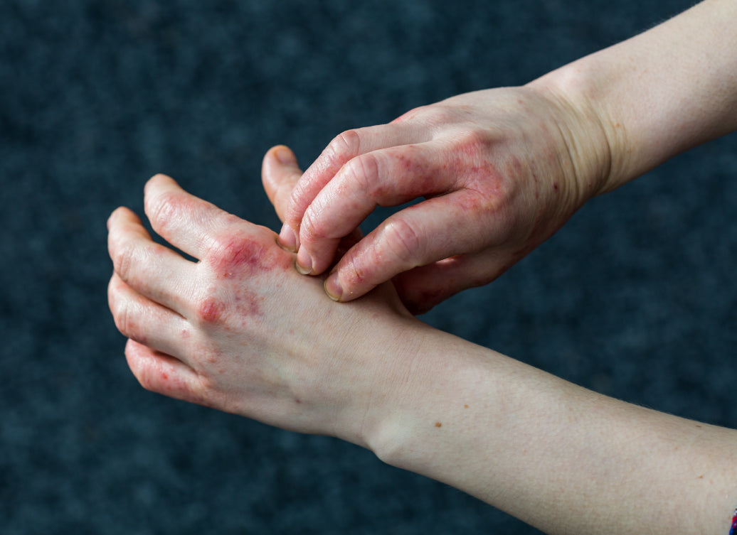 scratching Dyshidrosis on the back of a hand