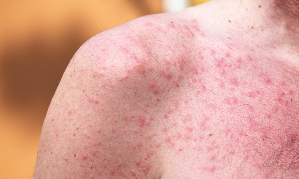 Polymorphic Light Eruption (PMLE) – Balmonds