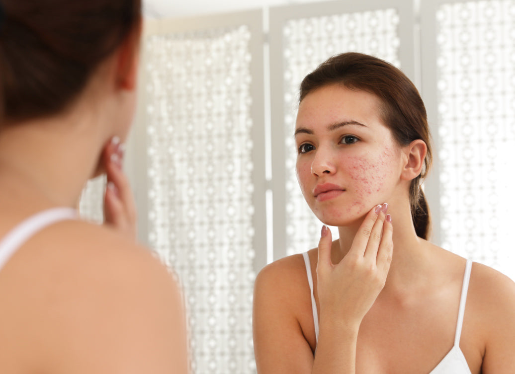 Is Rosacea A Symptom Of Something Else? – Balmonds