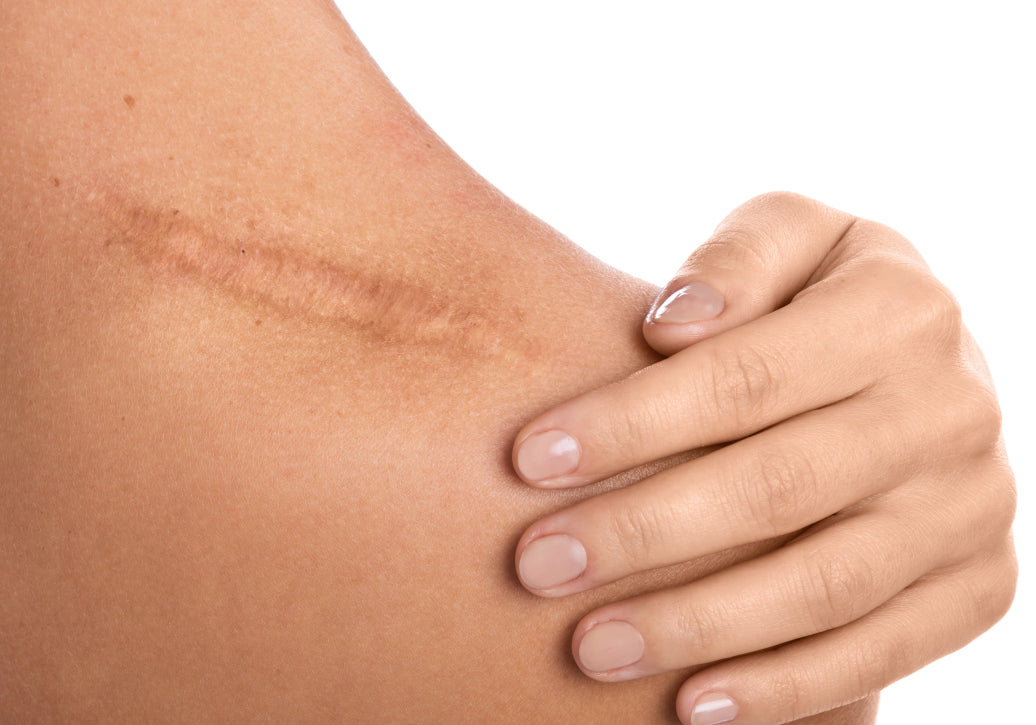 Scar on the back of a shoulder