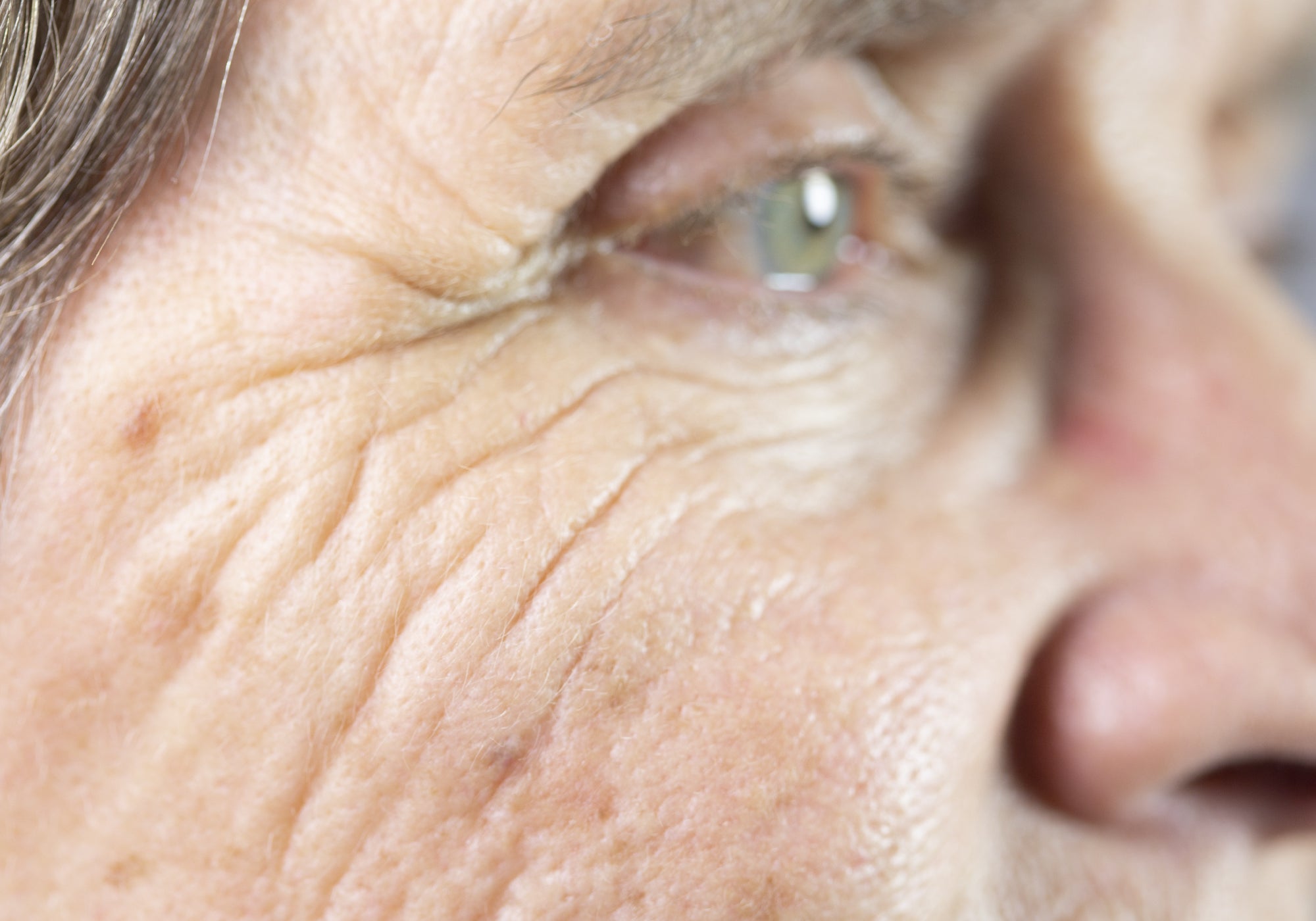 Actinic Keratosis on the side of the face and around the eye